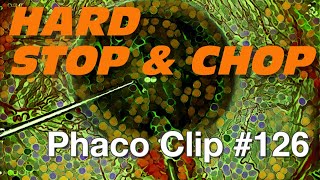 Phaco Clip #126 - Hard Stop & Chop