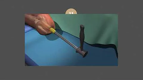 Rehab: Osseointegration prosthetic