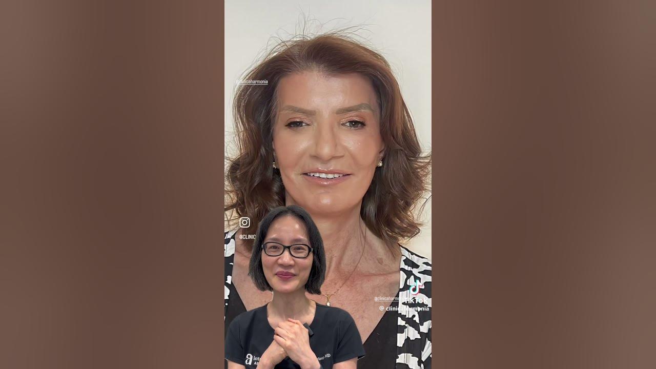 She shaved years off with A PHENOL PEEL! 😱🤩