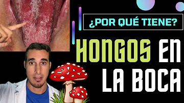 ¿Cuáles son los síntomas de los hongos labiales?