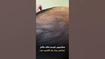 مەڵاشوو کەوتن چییە بۆچی نابێت دەست لە سەری منداڵی تازە لەدایکبوو بدرێت 