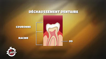 Comment lutter contre le Dechaussement des gencives