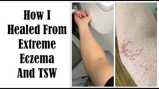 Top 10 Things To Heal From Eczema and TSW  My Journey of Healing