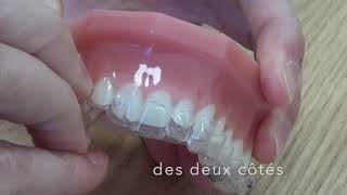 Comment mettre et retirer ses aligners Invisalign