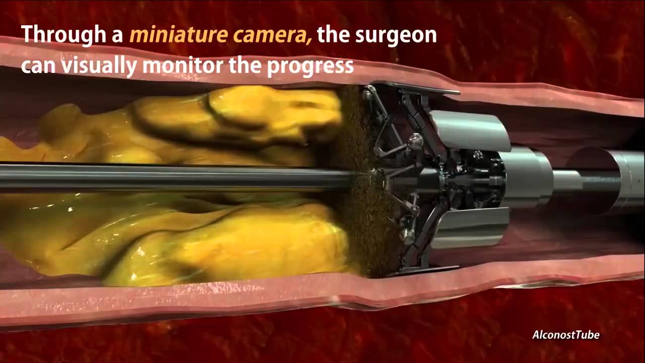 Natural Ways To Clear Blocked Arteries Natural Ways To Clear Blocked Arteries
