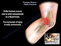 Fracture Femur Hoffa Fracture - Everything You Need To Know - Dr. Nabil Ebraheim