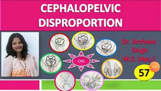 57. Cephalopelvic Disproportion