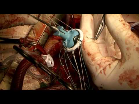 Video: Kirurgija Na Otvorenom Srcu: Rizici, Postupak I Priprema