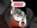 裂溝の虫歯を先生が説明!#short