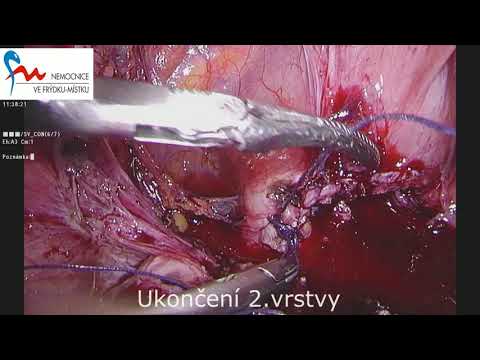 Video: Chirurgie - Novinka V Pooperační Léčbě Bolesti