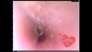 Vol2 Wet And Dry Mixed Ear Wax Removal Ear Cleaning Pick Mimikaki