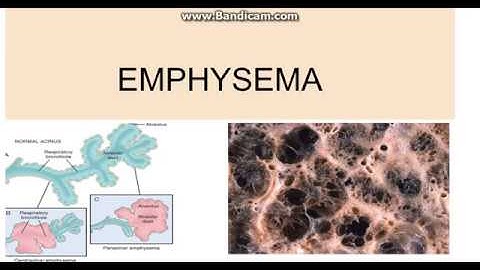 Emphysema gum disease skin discoloration and leukemia