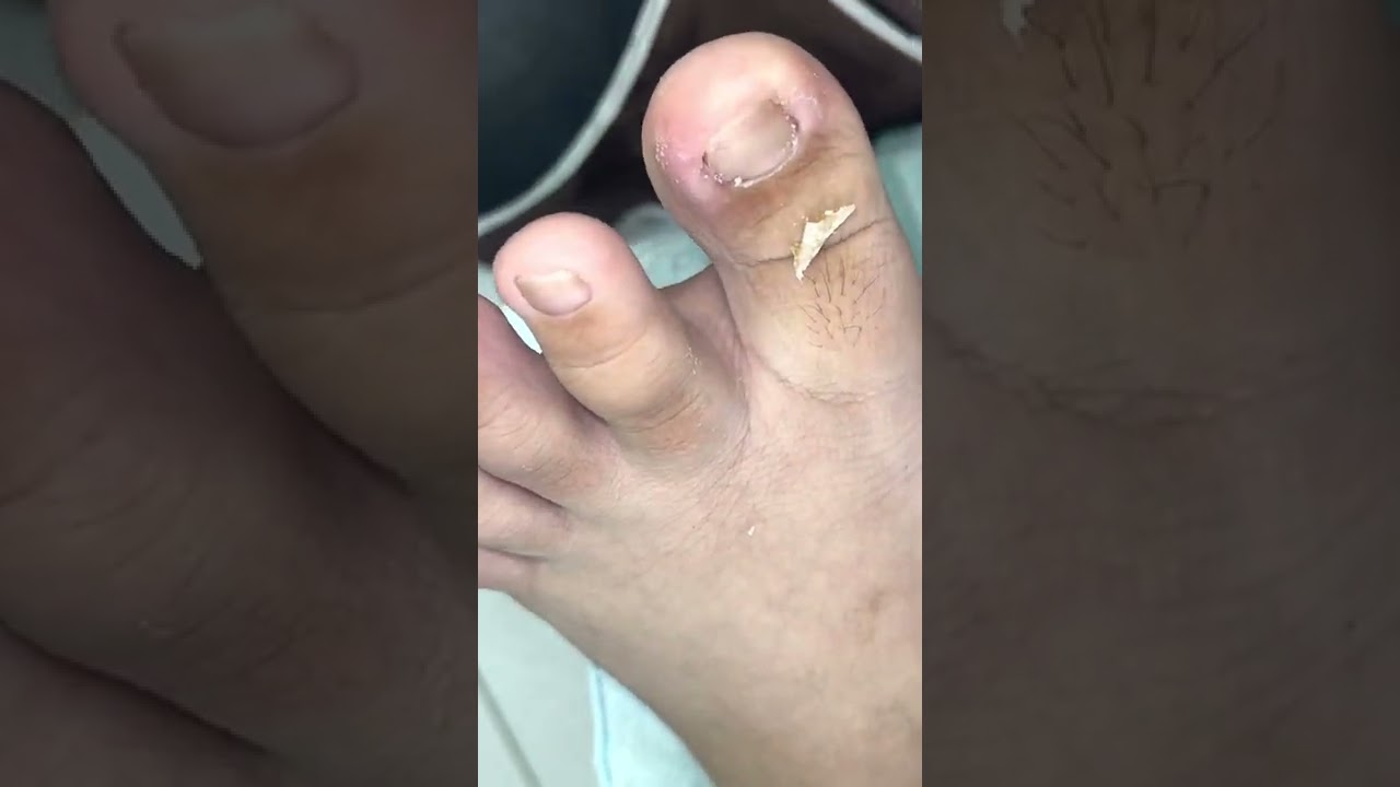 Ep_4007 Ingrown toenail removal 👣 การปล่อยให้ข้างเล็บแห้ง..มีผลอะไรครับ