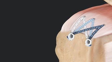 FiberTak® SpeedBridge™ Rotator Cuff Repair