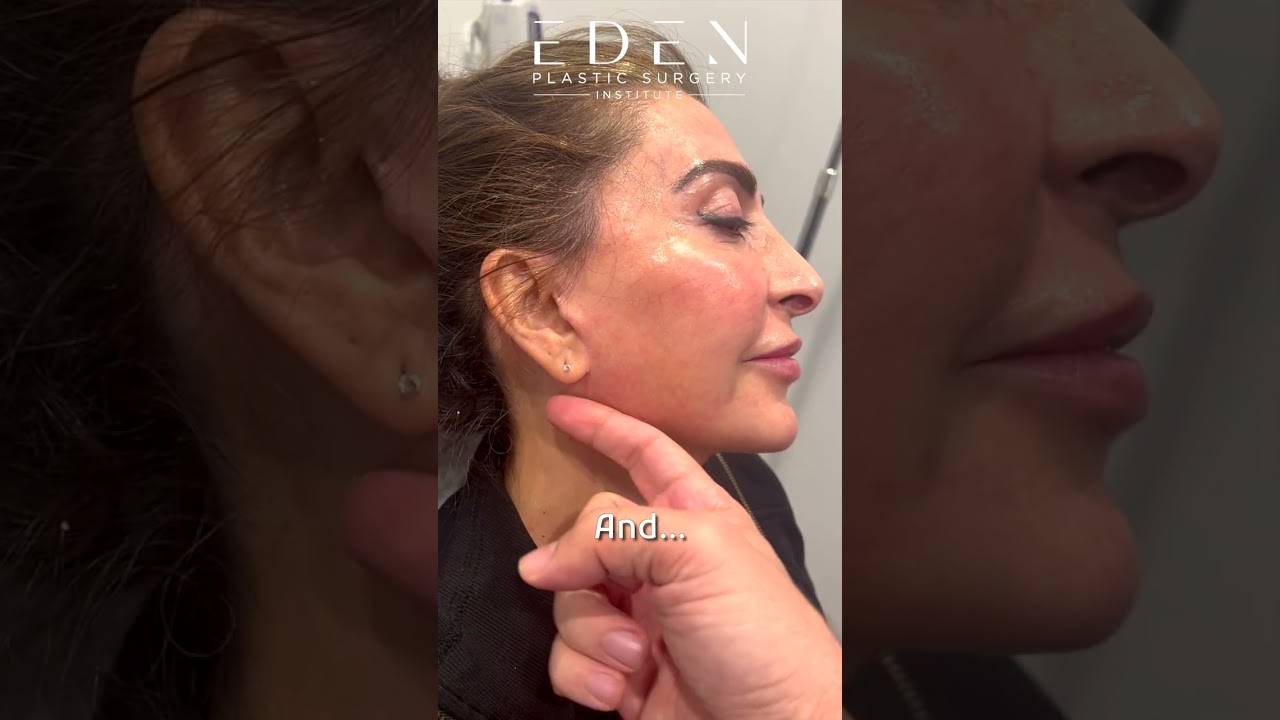 EVE LIFT™ One Year Post Surgery Before and After | Eden Plastic Surgery Ali Charafeddine, MD