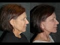 Local Anesthesia Facelift Without Surgery Anesthesia | Dr Jacono #facelift