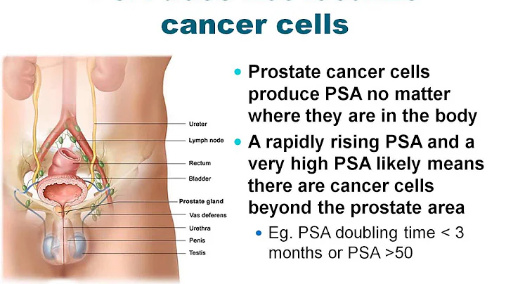 Expert Angle: Prostate Cancer, What Should I Be Do...