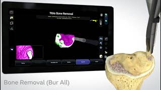 The CORI Surgical System by Smith+Nephew