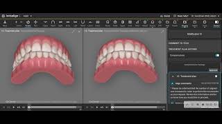 Reversing The Effects Of Arch Narrowing From 4 Premolar Extraction