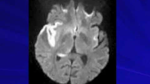 Aseptic Meningitis  --  Ana Velez, MD