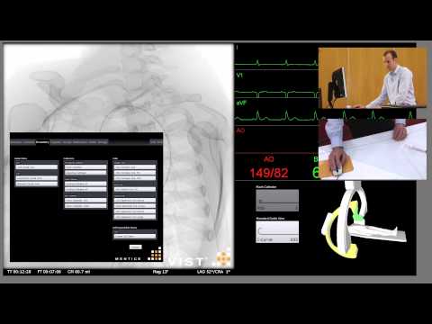 Aortic Arch Angiogram