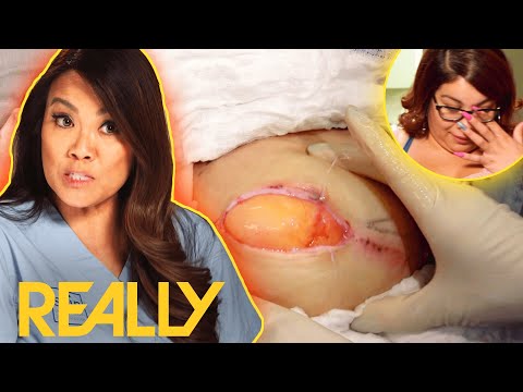 Lipoma Is So Big It Looks Like A Third Breast | Dr. Pimple Popper