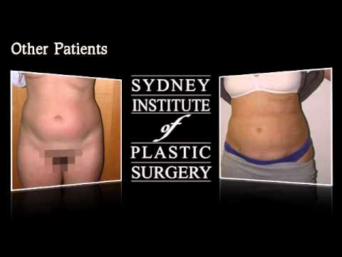 Laser Liposuction Before And After Slimlipo Youtube