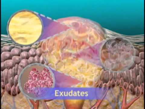 VATM – Sinh lý bệnh quá trình viêm || Ycotruyen.com.flv