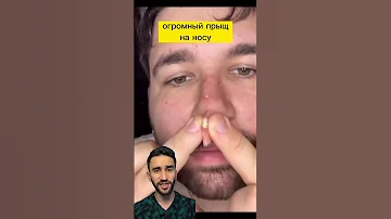 гигантский прыщ на носу