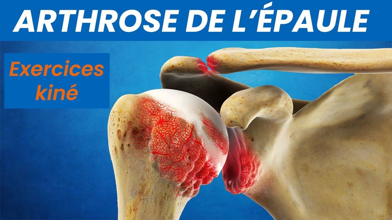 Comment Faire Pour Ne Pas Avoir L'artrose