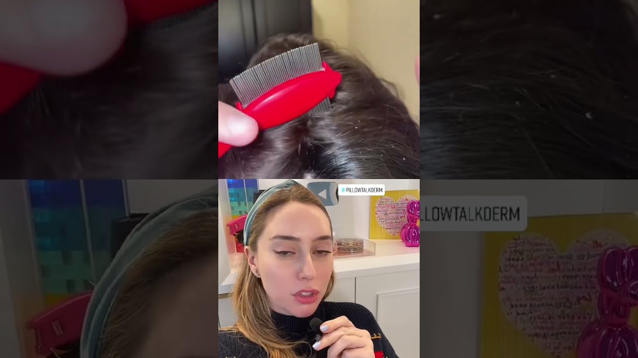 Scalp Psoriasis What NOT To Do Shorts