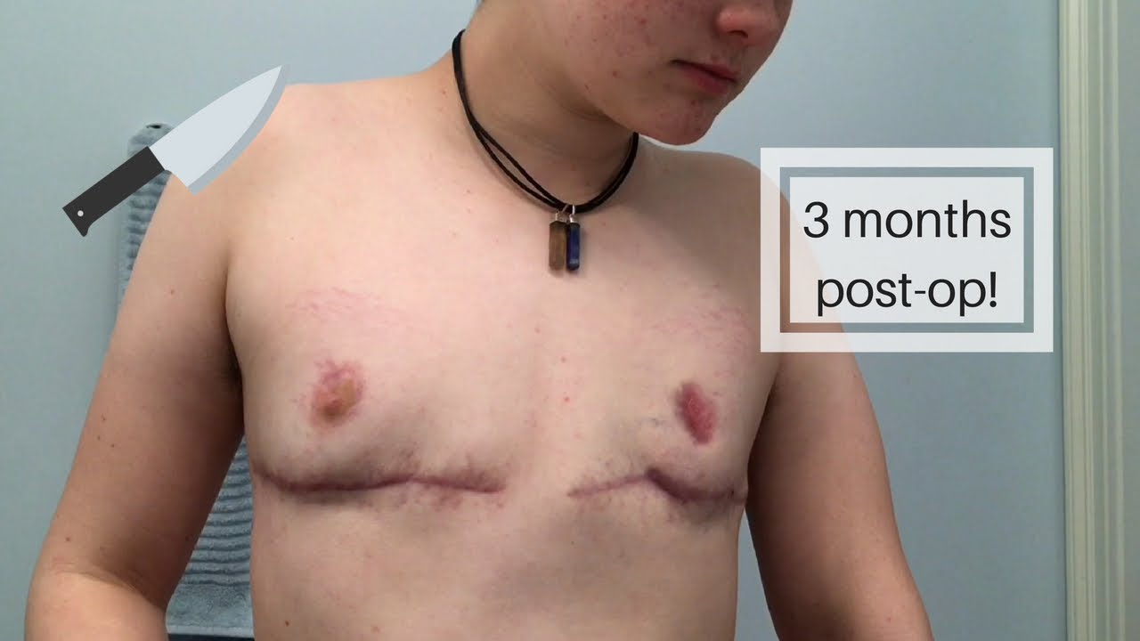 3-months-post-op-double-incision-top-surgery-youtube