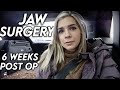 Jaw Surgery... 6 weeks later: Finally looking like myself again