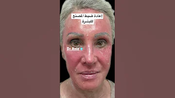 التقشير الكيميائي بإستخدام الفينول 