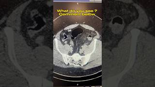 CT Scan Perforated Diverticulitis #ctscan #diverticulitis #surgery