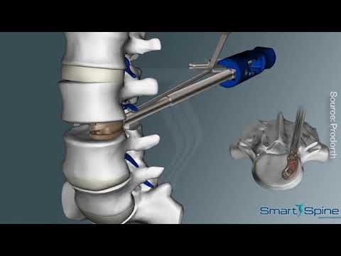 Phẫu thuật thay đĩa đệm cột sống nhân tạo #4med