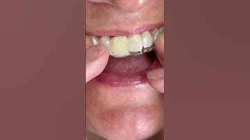 When placing implant!