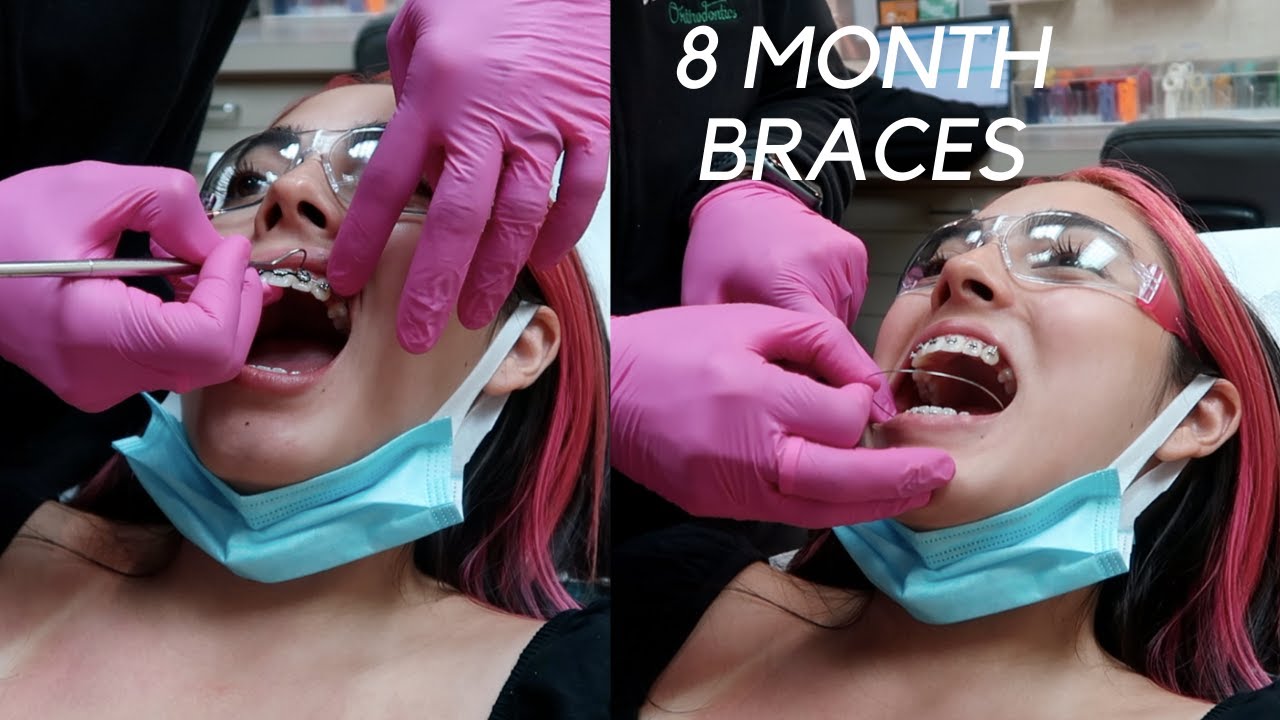 8 MONTH BRACES UPDATE (POST QUARANTINE + RUBBER BANDS)