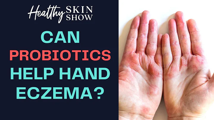 How PROBIOTICS Helped My Hand Eczema | Nora Ureste