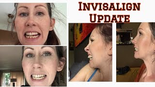 Things you might not know about Invisalign / Week 32 update & Progress pictures