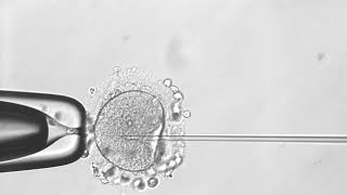 Интрацитоплазматическое введение сперматозоида в яйцеклетку ИКСИ ICSI