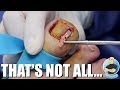 A SUPER SERIOUS INFECTED INGROWN TOENAIL