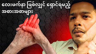 လေးဖက်နာ ဖြစ်လျှင် ရှောင်ရမည့် အစားအစာများ