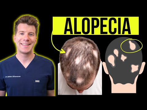 Video: Alopēcija