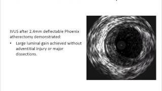 Phoenix with IVUS Case Review Case - Dr. Crowder