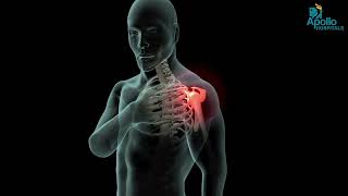 Chirurgie De Remplacement Dépaule Dr. Karthik Reddy Pammi Apollo Hospital