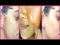 Permanent Facial Hair Removal With TOMATO Peel Off Mask 100% Works || Healthcare Plus