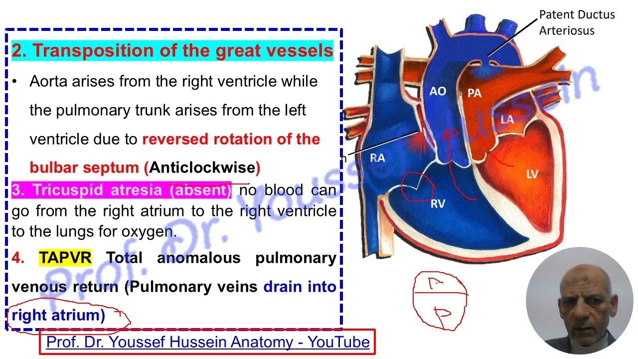 Right to left Shunts- Left to right shunts- Fallot's tetralogy- Eisenmenger syndrome
