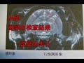【猫記録503】てんかん２MRIで衝撃の検査結果が!!