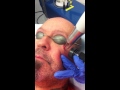 Teardrop tattoo removal  a lifechanging procedure